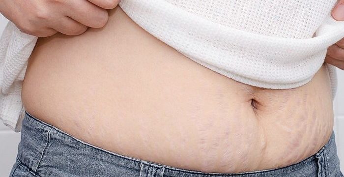 top home made remedies for stretch marks